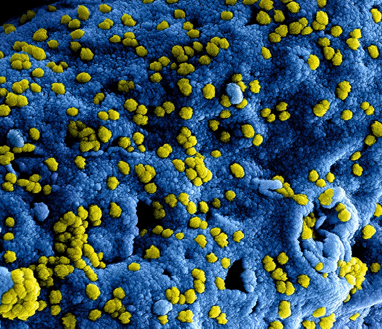 Nuovo caso di morbillo in un bambino. Cresce la preoccupazione tra i genitori Immagine selezionata